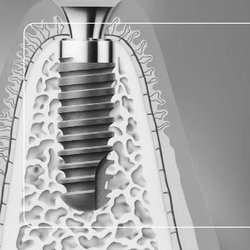 Afbeelding brochure Implantaten